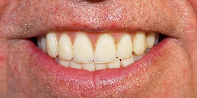 Dental Implant Patient 1 After Treatment