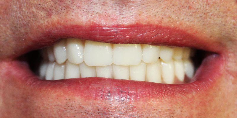 Dental Implant Patient 3 After Treatment