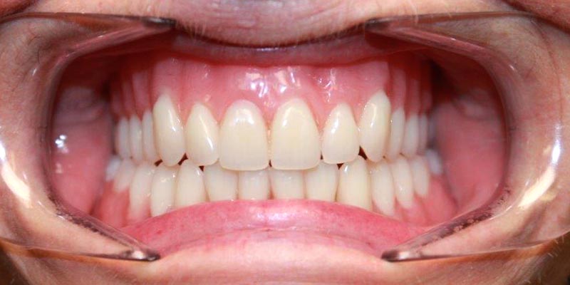 Dental Implant Patient 4 After Treatment Dental Implant Patient 4 After Treatment