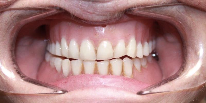 Dental Implant Patient 4 Before Treatment Dental Implant Patient 4 Before Treatment