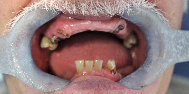 Dental Implant Patient 9 Before Treatment