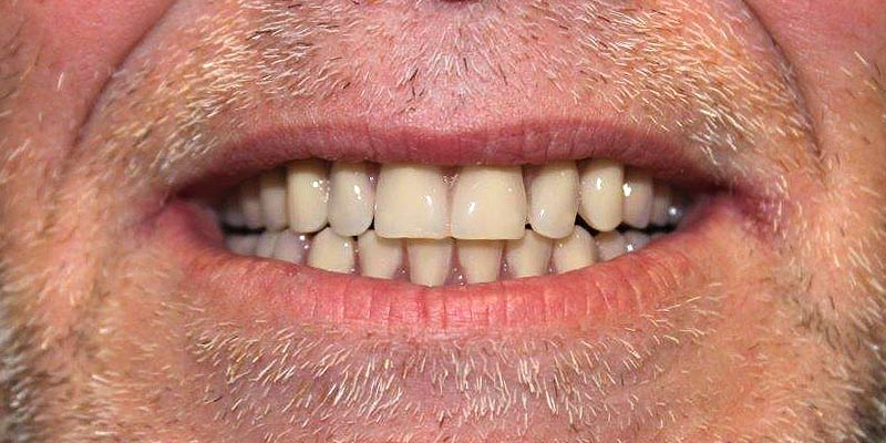 Dental Implant Patient 10 After Treatment Dental Implant Patient 10 After Treatment