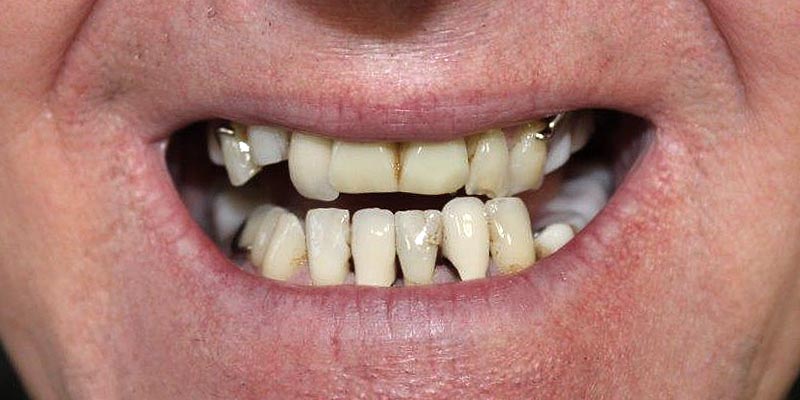 Dental Implant Patient 15 Before Treatment