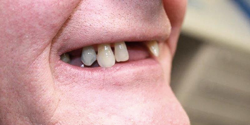 Dental Implant Patient 16 Before Treatment
