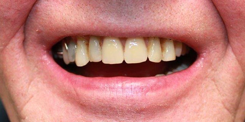 Dental Implant Patient 17 After Treatment