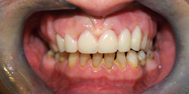 Dental Implant Patient 18 After Treatment