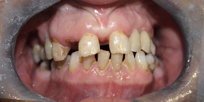 Dental Implant Patient 18 Before Treatment