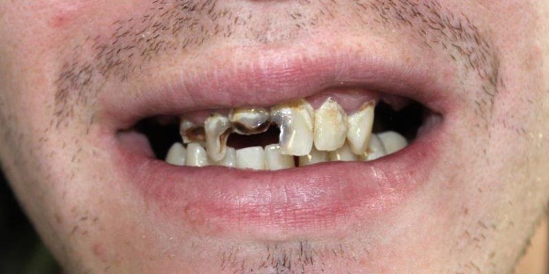 Dental Implant Patient 19 Before Treatment