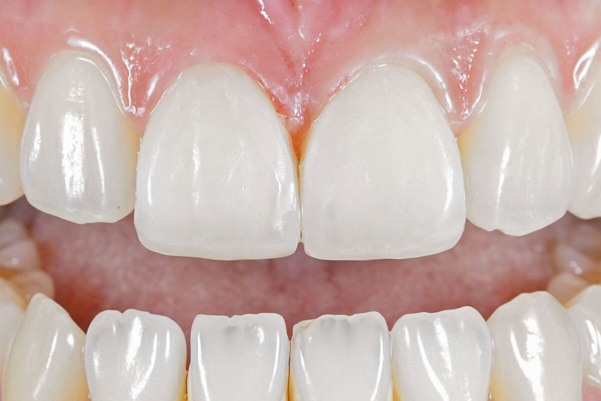 Composite Bonding for Gaps in Teeth, Stoke-on-Trent