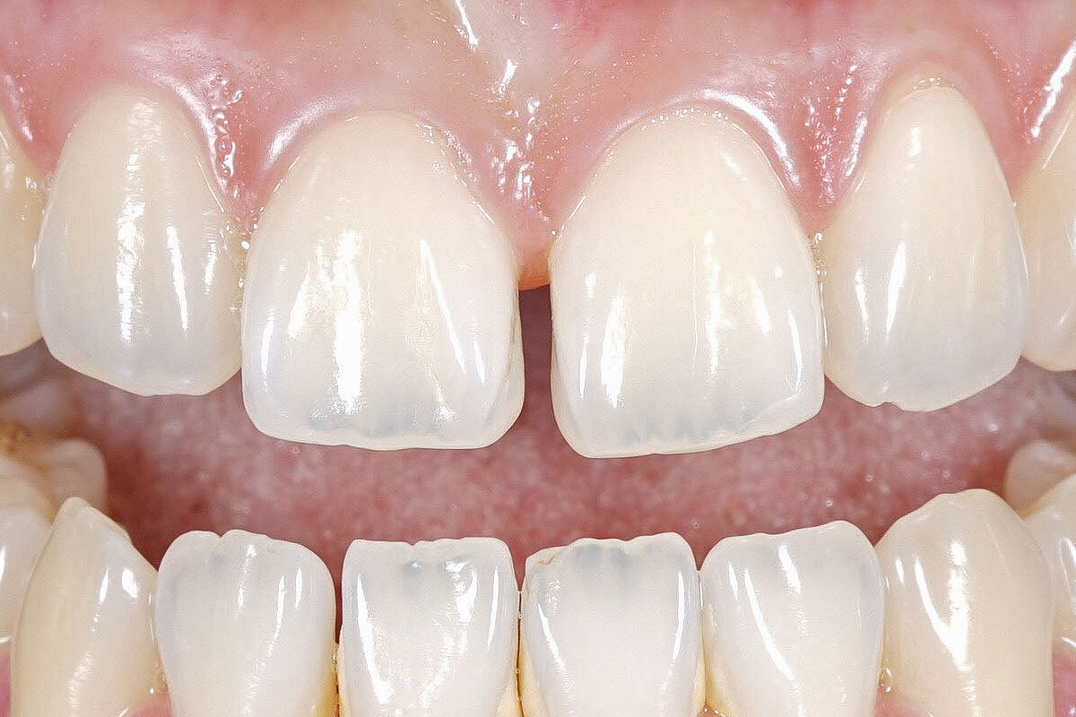 Composite Bonding for Gaps in Teeth, Stoke-on-Trent