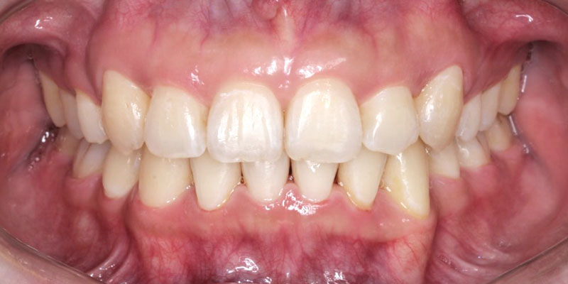 Invisalign® Patient 1 After Treatment