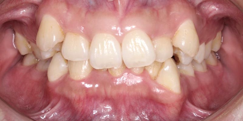 Invisalign® Patient 1 Before Treatment