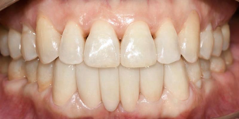 Invisalign® Patient 2 After Treatment