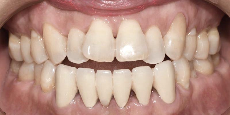 Invisalign® Patient 2 Before Treatment