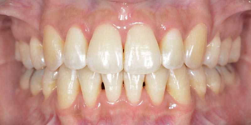 Invisalign® Patient 4 After Treatment