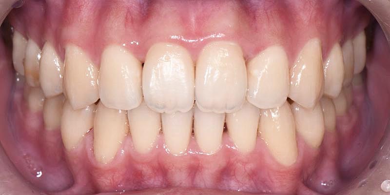 Invisalign® Patient 6 After Treatment