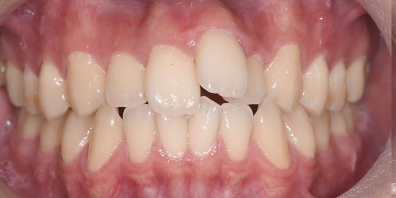 Invisalign® Patient 6 Before Treatment