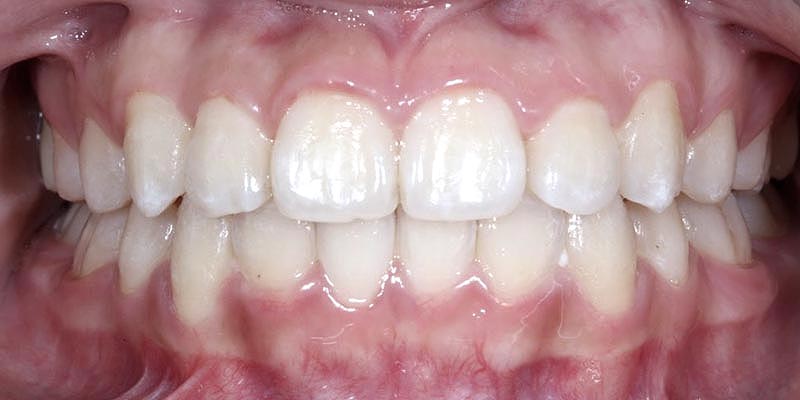 Invisalign® Patient 7 After Treatment