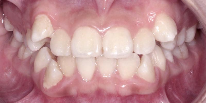 Invisalign® Patient 7 Before Treatment