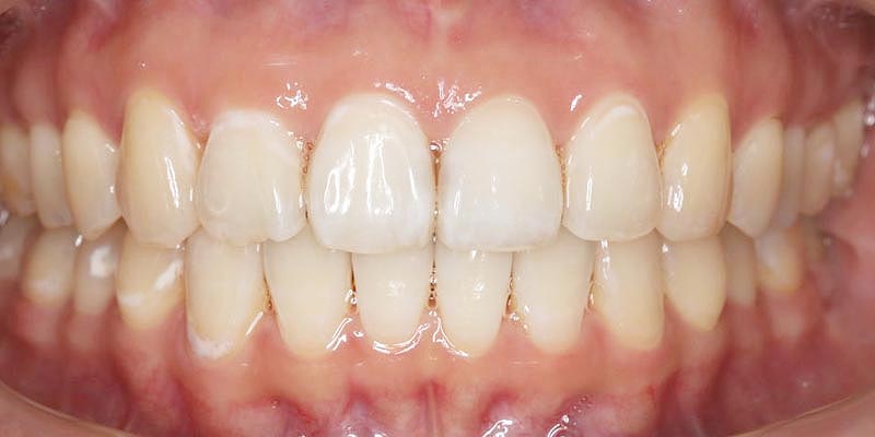 Invisalign® Patient 8 After Treatment